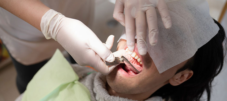 精密印象（型取り）