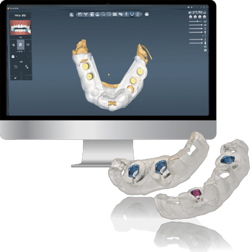サージカルガイドの患者様のメリット