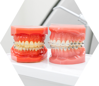 矯正治療中・ブリッジやかぶせ物がある。そんな方も可能です 画像03