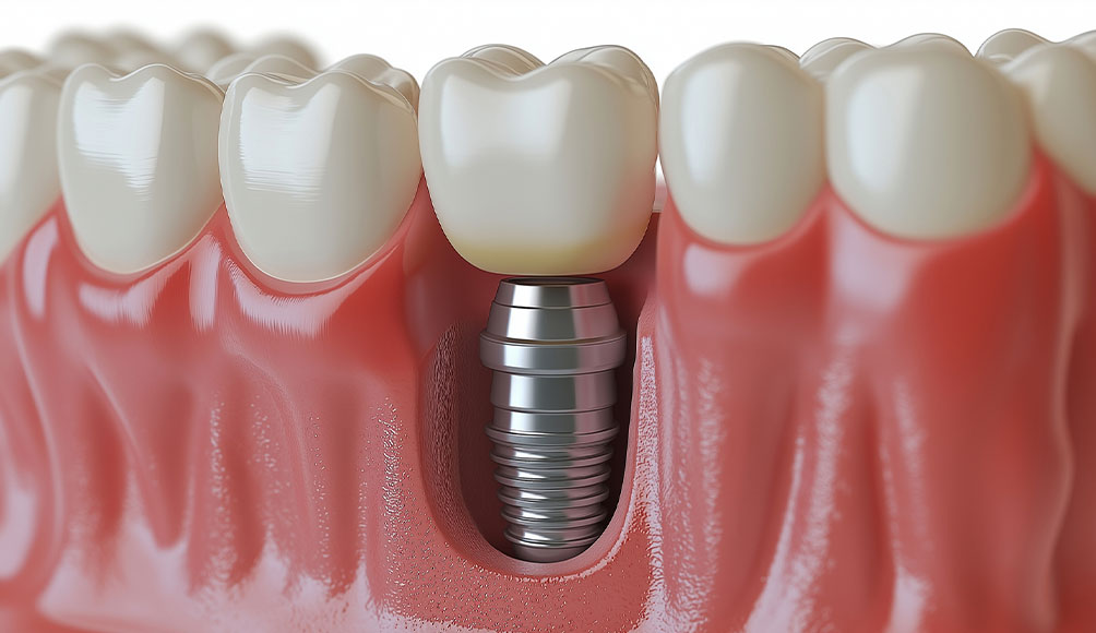 インプラント１本